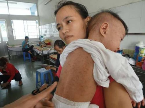 仰光省五个镇区发生麻疹传染病症
