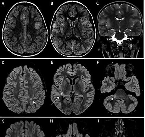 台湾地区多名儿童感染新冠后出现脑炎，是感染后的新症状吗？